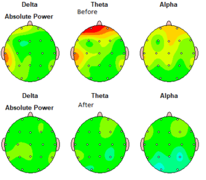 QEEG before and after neurofeedback